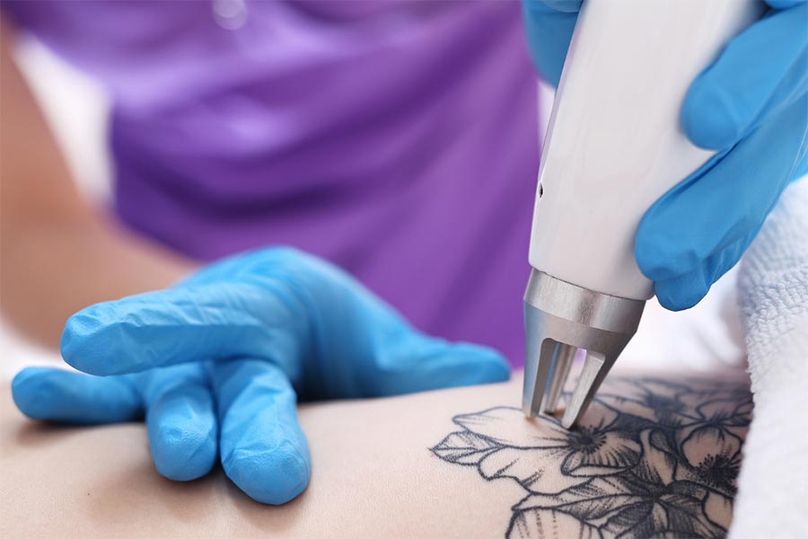 Laserowe usuwanie tatuażu - przebieg i efekty